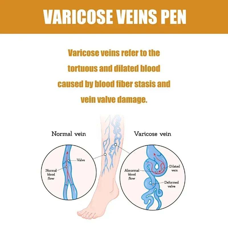Laser Therapy Leg Repair Pen Reduce Imcomfortable For Legs Improving Blood Circulation Varicose Veins Pen Skin Care Product