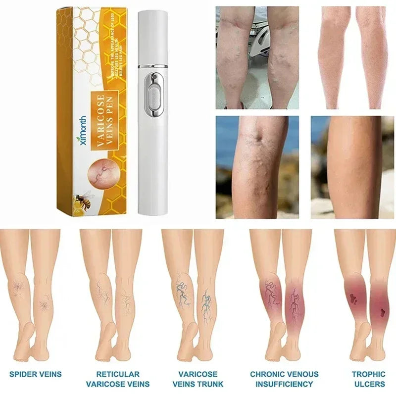 Laser Therapy Leg Repair Pen Reduce Imcomfortable For Legs Improving Blood Circulation Varicose Veins Pen Skin Care Product