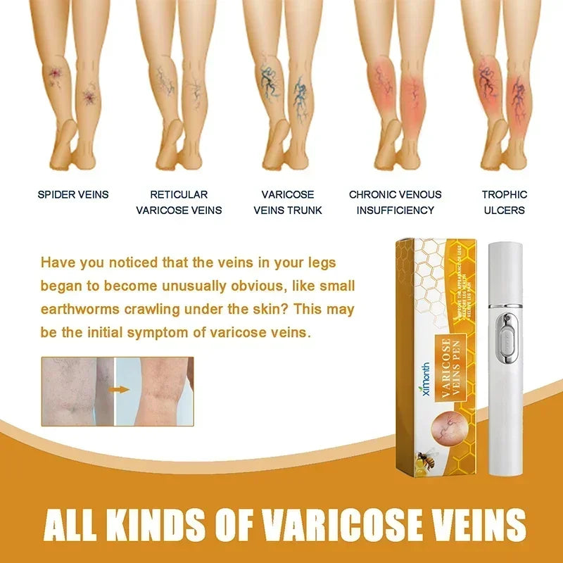 Laser Therapy Leg Repair Pen Reduce Imcomfortable For Legs Improving Blood Circulation Varicose Veins Pen Skin Care Product