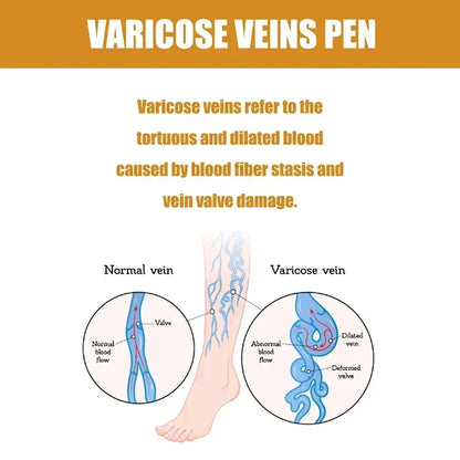 Laser Therapy Leg Repair Pen Reduce Imcomfortable For Legs Improving Blood Circulation Varicose Veins Pen Skin Care Product